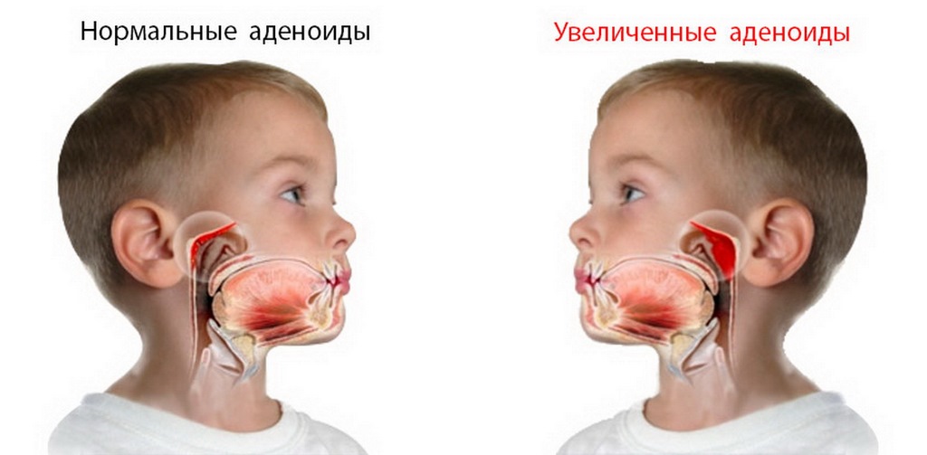 Как аденоиды могут вызвать ночное недержание у детей