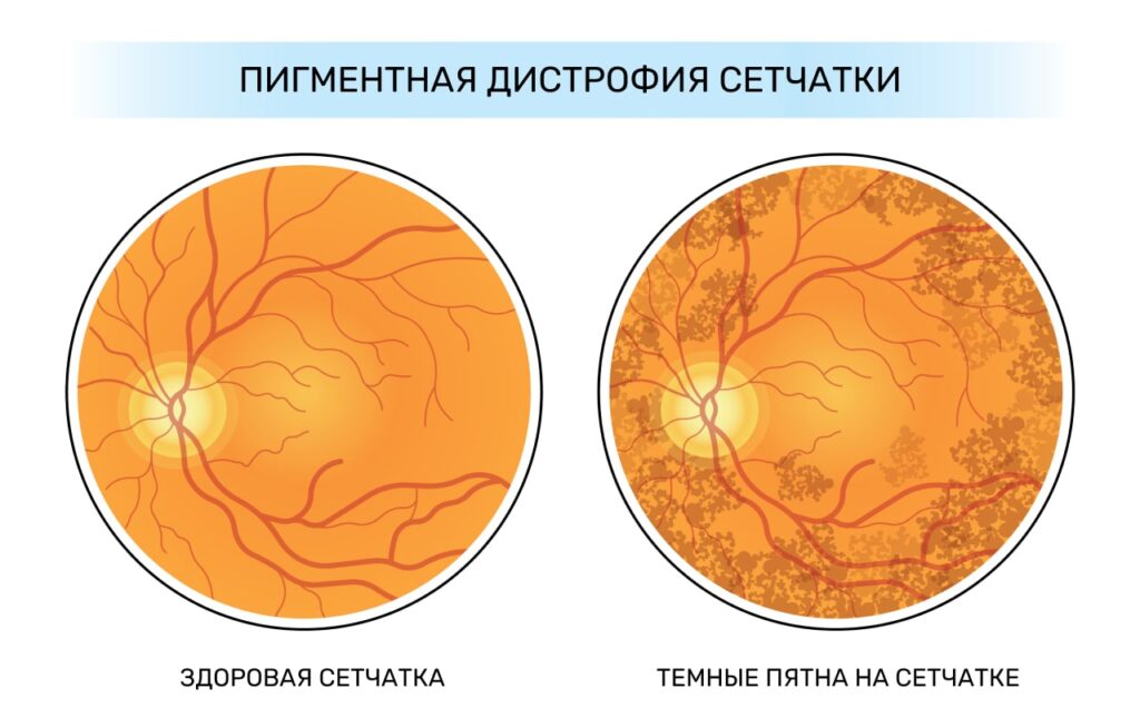 Говорят, что самое опасное заболевание глаз – дистрофия сетчатки. Что это и кто в зоне риска?