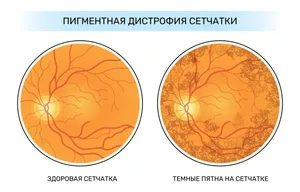 Говорят, что самое опасное заболевание глаз – дистрофия сетчатки. Что это и кто в зоне риска?